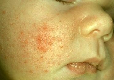 parasieten onder de huid van een kind