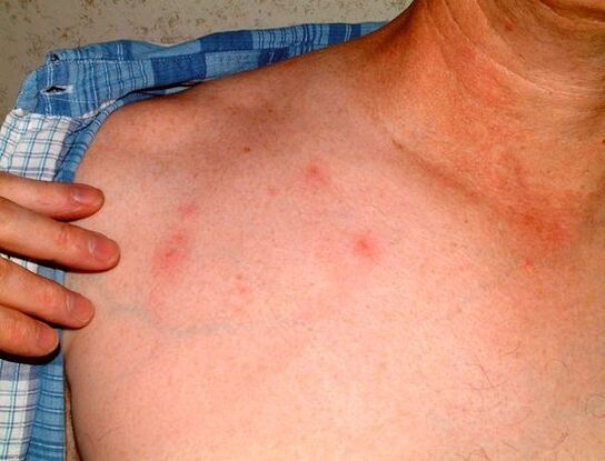 symptomen van parasieten onder de huid