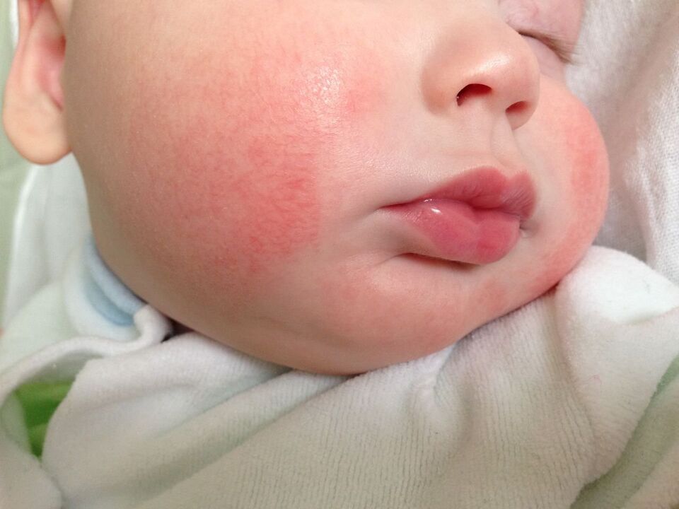 Een teken van wormen bij een kind is allergische urticaria